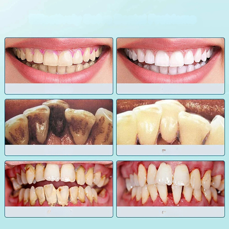 SmilePro Ultraschall Zahnsteinreiniger – Effektiver Plaqueentferner für Zuhause