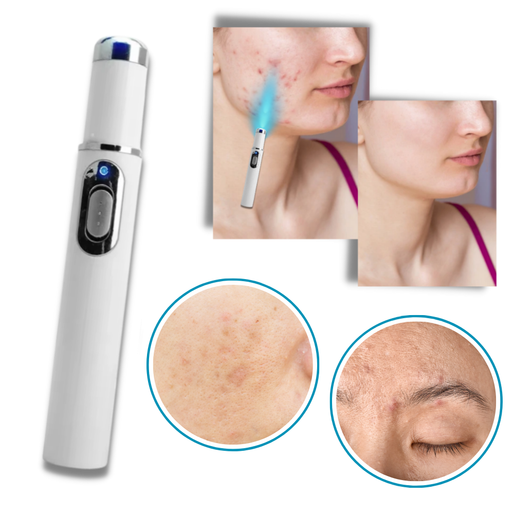 Dunkelheitsflecken Entferner Blauer Laser Stift