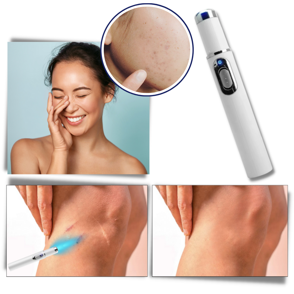 Dunkelheitsflecken Entferner Blauer Laser Stift